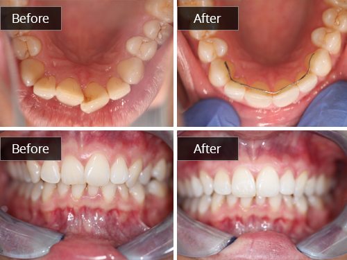 Teeth Straightening 1