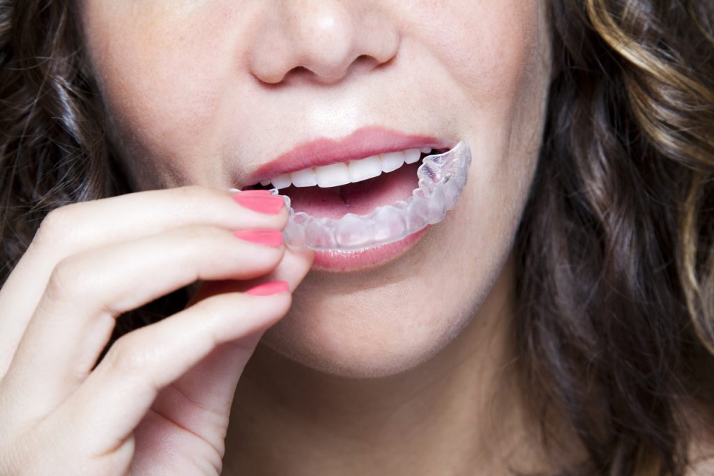 Tips to look after your Invisalign braces